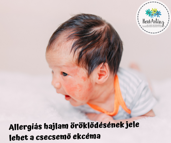 Allergiás hajlam öröklődésének jele lehet a csecsemő ekcéma szakértői cikk HerbArting