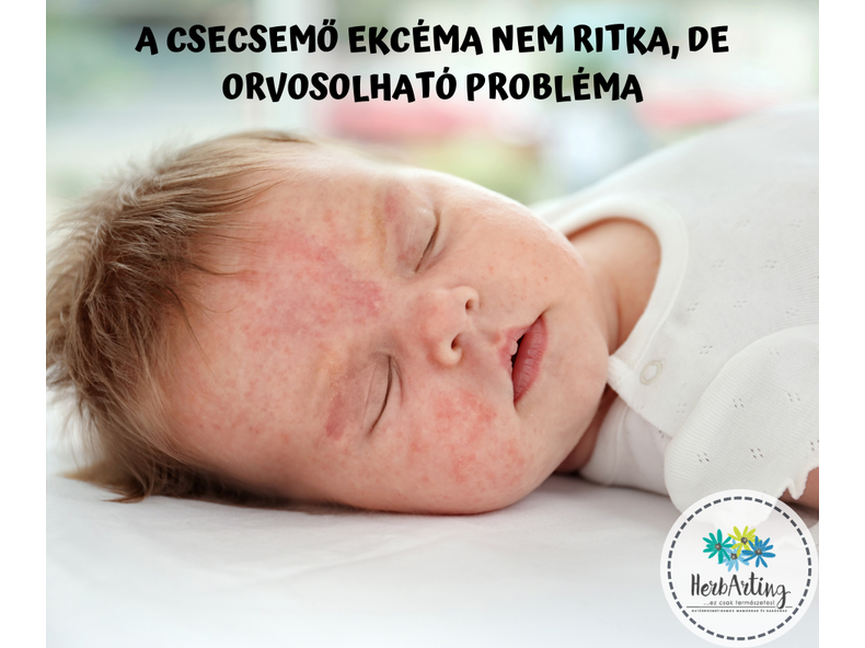 A csecsemő ekcéma nem ritka, de orvosolható probléma