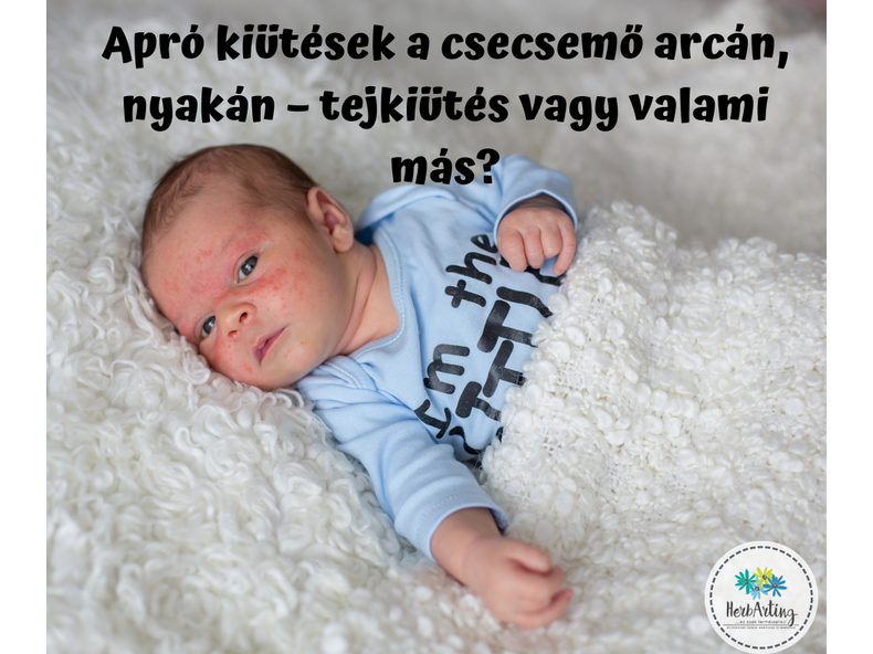 Apró kiütések a csecsemő arcán, nyakán – tejkiütés vagy valami más?
