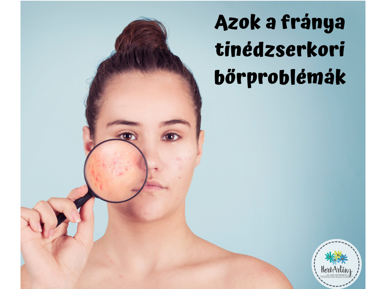 Azok a fránya tinédzserkori bőrproblémák