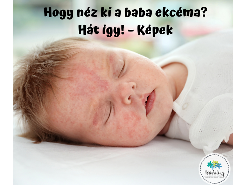 Hogy néz ki a baba ekcéma? Hát így! – Képek