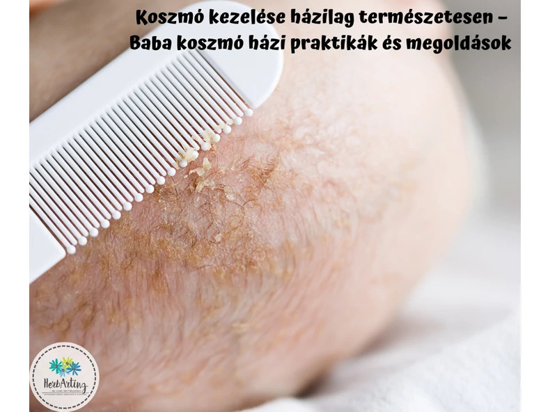 Koszmó kezelése házilag természetesen – Baba koszmó házi praktikák és olajos megoldások